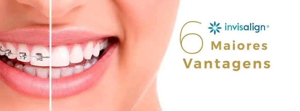 6 Vantagens que Vão te Convencer a Optar Por Alinhadores Transparentes