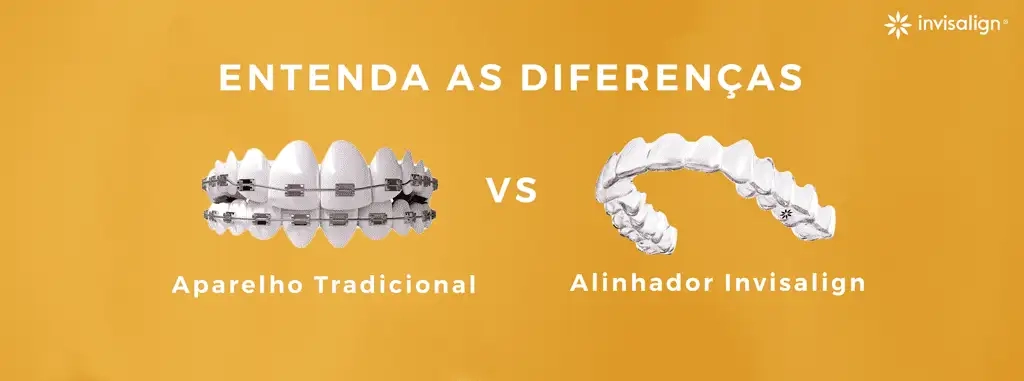 Aparelho Ortodôntico Tradicional vs Alinhador Transparente Invisalign | Entenda as Diferenças