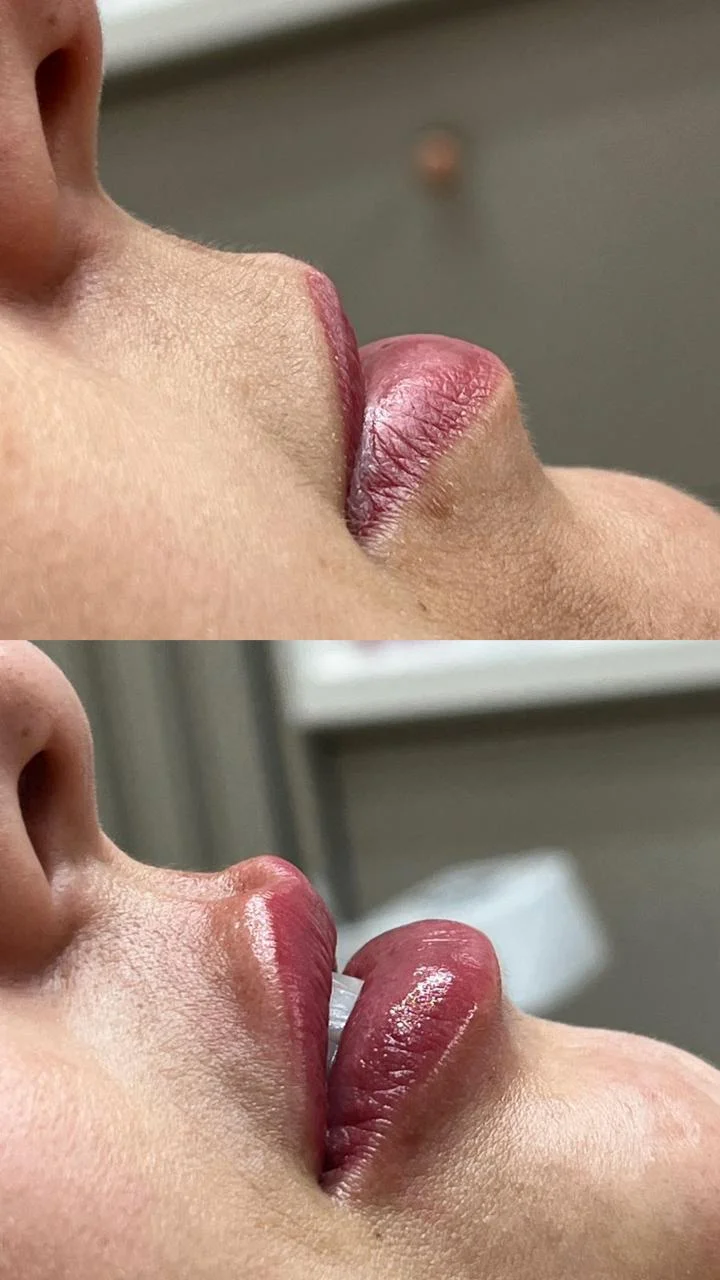 Preenchimento Labial