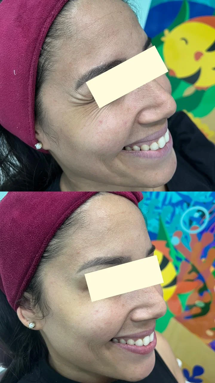 Bioestimulação de Colágeno