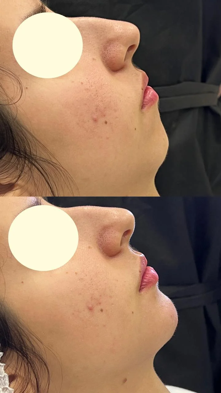 Preenchimento e Lifting Facial com Ácido Hialurônico