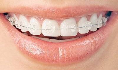 Alinhador Tradicional vs Alinhador Invisalign